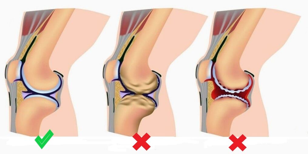 Depanten prevén o desenvolvemento de artrite e osteoartrite