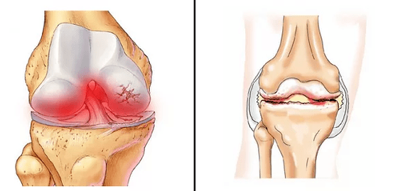 Comparación de artrose de artrite