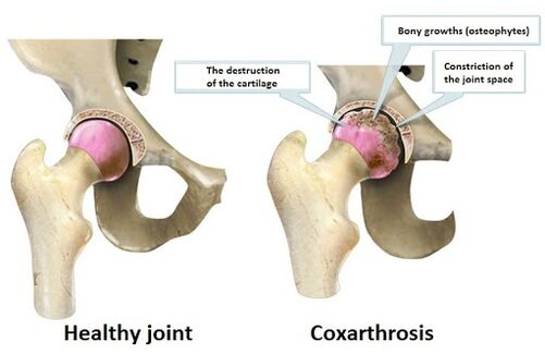 Articulación sa, que está afectada pola articulación de coksarrose