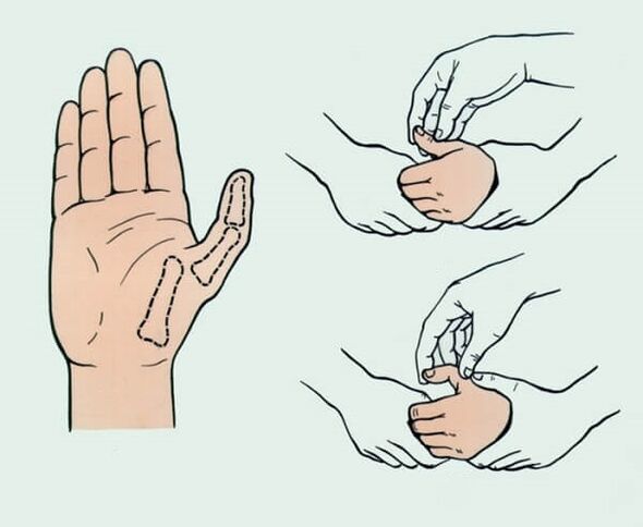 Reposicionamento dun dedo luxado, necesario para eliminar a dor articular