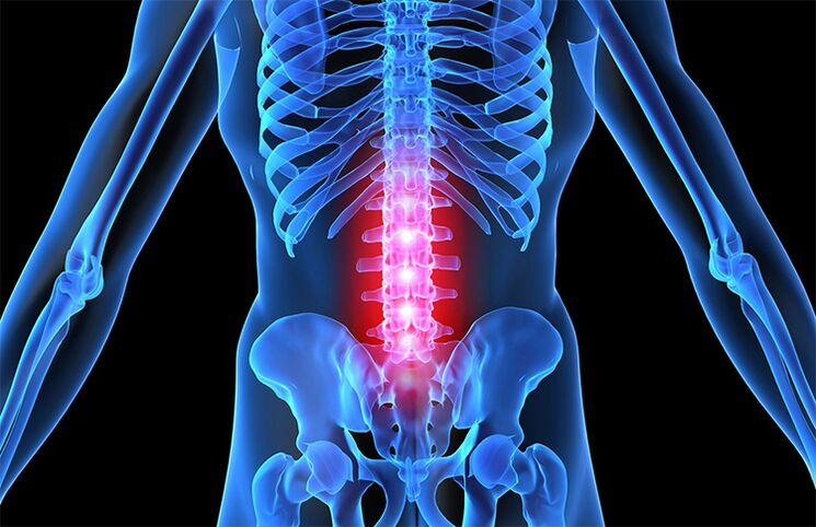 Osteocondrose da columna lumbar