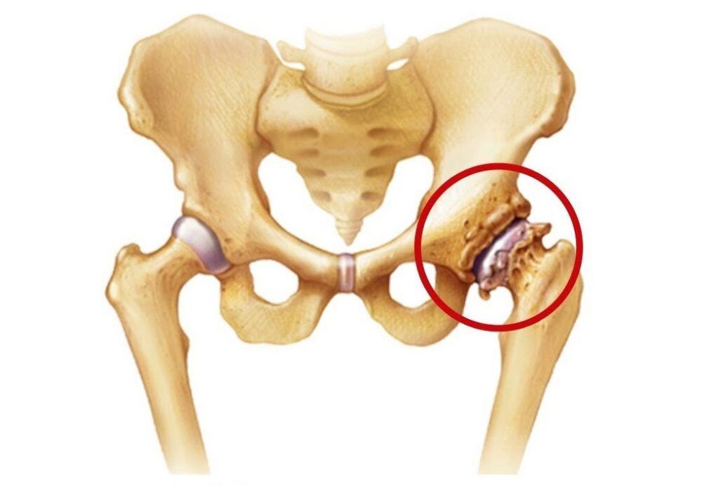 Articulación da cadeira afectada pola artrose