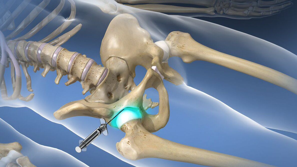 Bloqueo intraarticular para a dor severa da artrose de cadeira