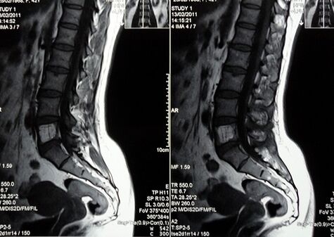 Resonancia magnética da columna lumbosacra para diagnosticar dor nas costas