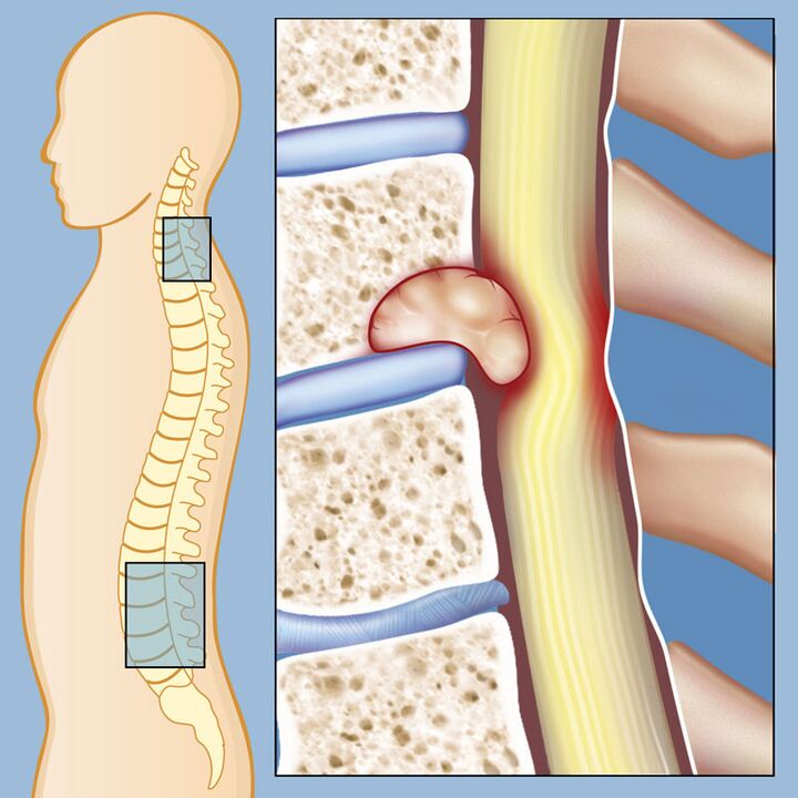 Tumor maligno como causa de dor lumbar severa